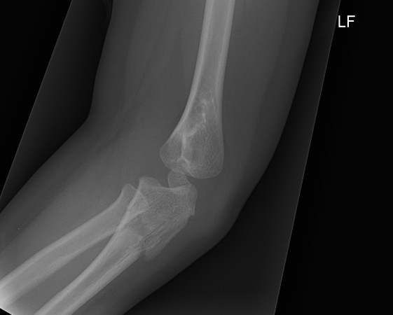 Paediatric Monteggia Lateral